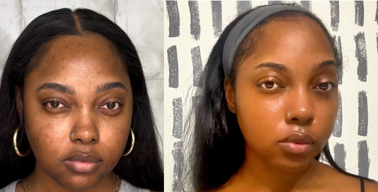 Morgan Ashley melanin-rich skin before and after hyperpigmentation treatment — dark skin over 40